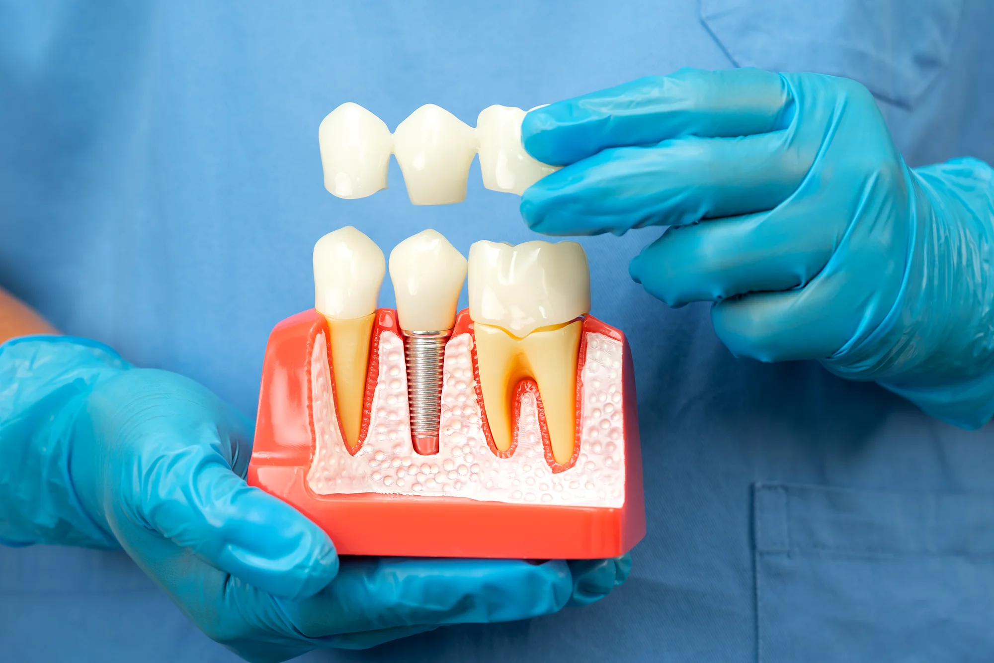 Dental implants Beaverton Oregon - permanent tooth replacement at Aloha Dental Specialty Center