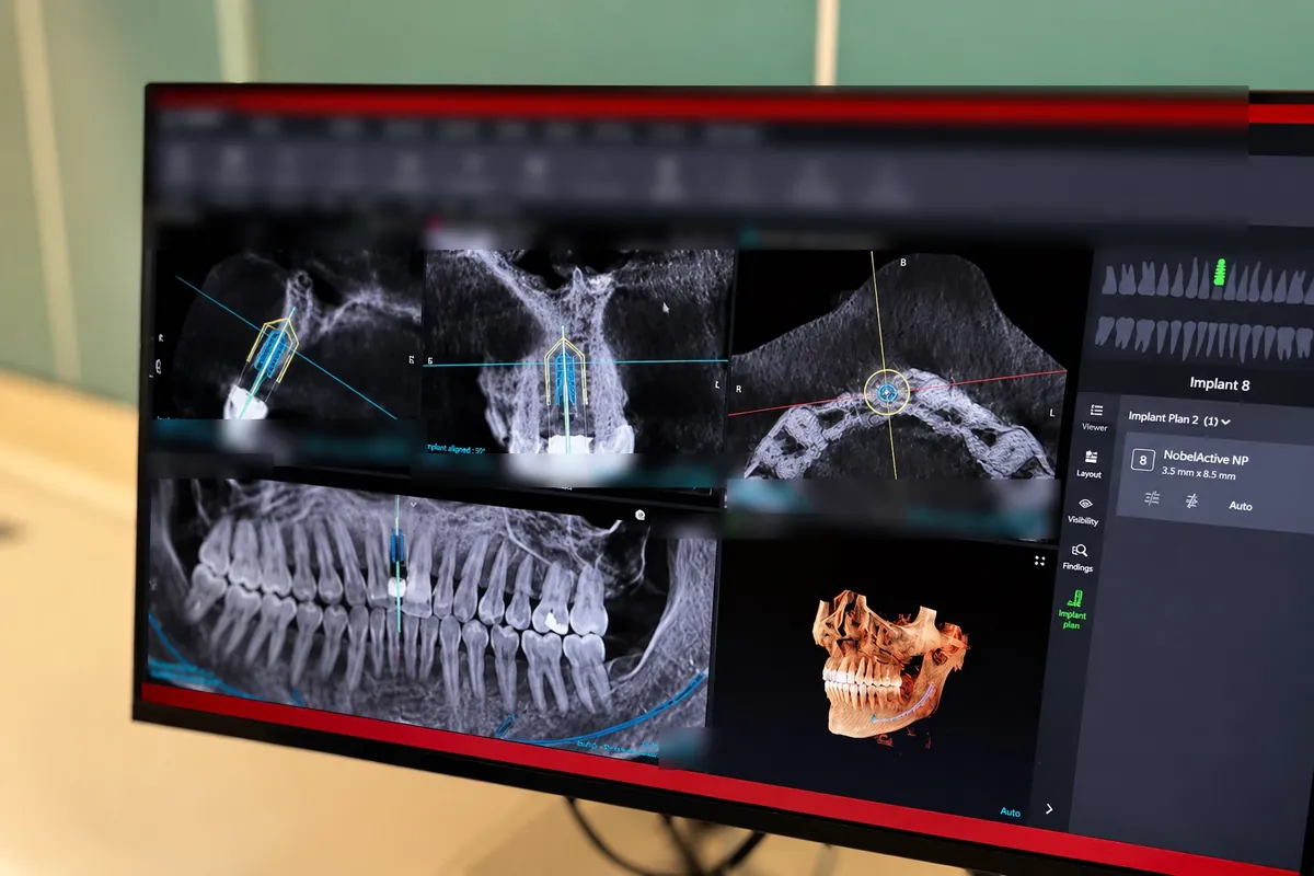 Implant planning view in 3D CBCT software with cross-sections of the upper jaw