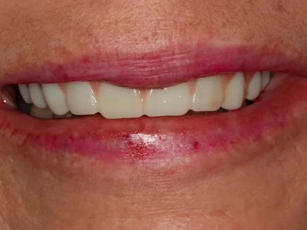 After: a full row of fixed implant-supported teeth in the upper arch