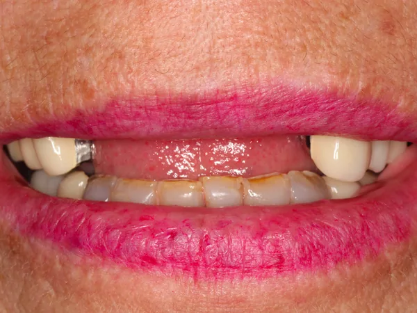 Before: upper front teeth missing, with a few remaining upper back teeth and worn lower teeth
