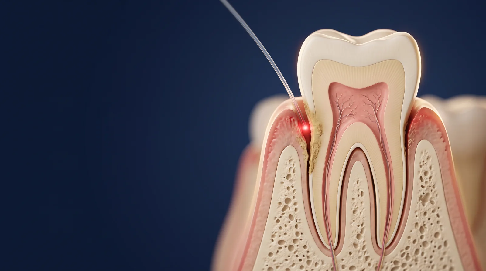 Medical illustration showing a periodontal pocket and LANAP® laser treatment around a tooth