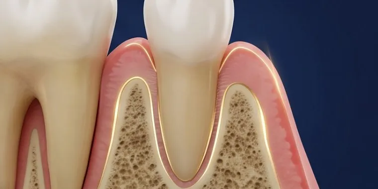 Illustration of healed gum and bone around the tooth root