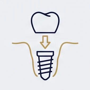 Line icon of an implant post set below the gum line with a crown above it, stage four of the implant journey